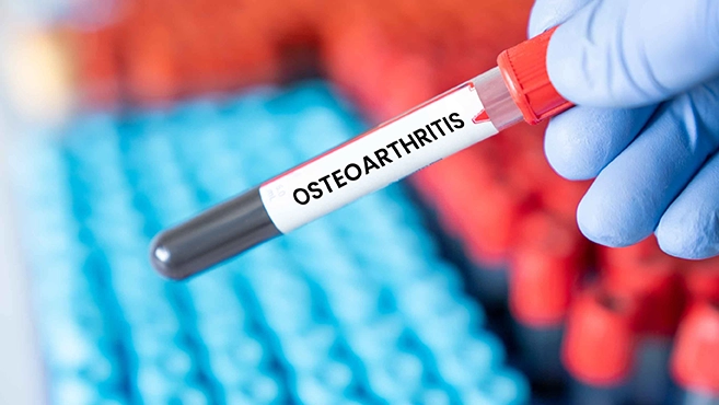 NNOsteoarthritis1